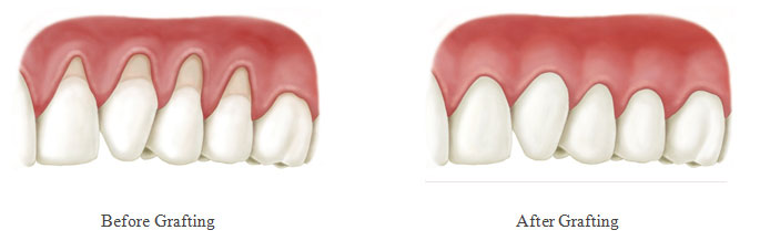 Gum grafting before and after