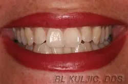 Adult orthodontics before