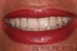 Adult orthodontic after
