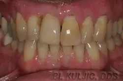 Surgical dentistry - Single Implant and a few bondings after