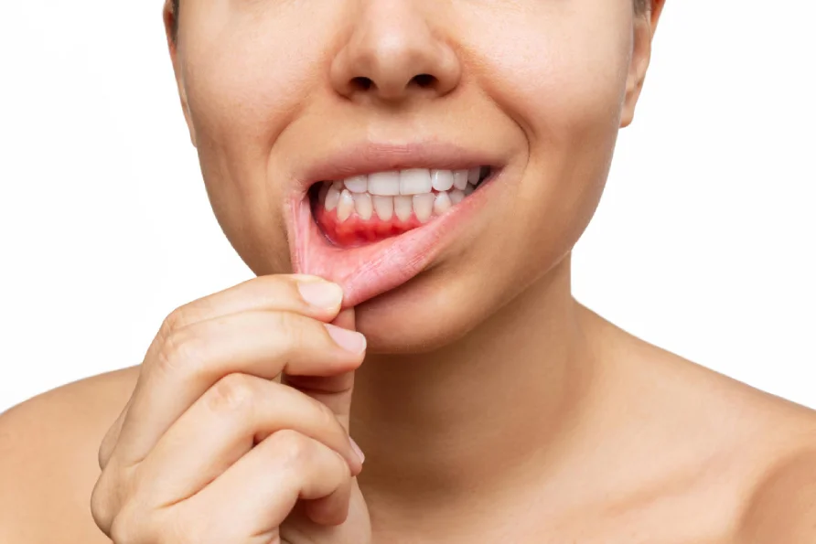 Woman shows gum disease