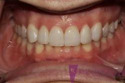 Neta - teeth after porcelain veneers treatment