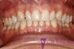 Neta - teeth before porcelain veneers treatment