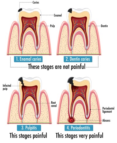The Stages of caries development