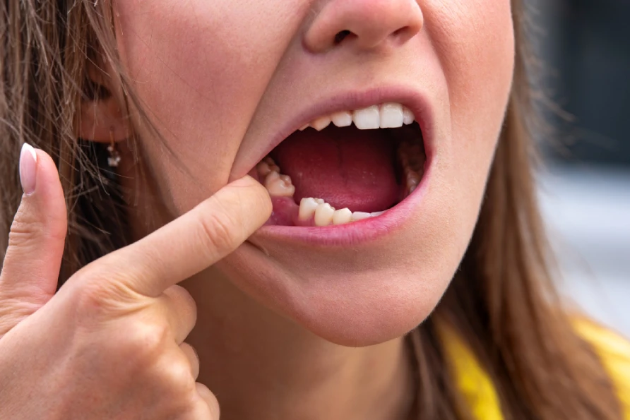 Dental patient with a broken tooth at the gum line receiving an oral evaluation at a dentist’s office