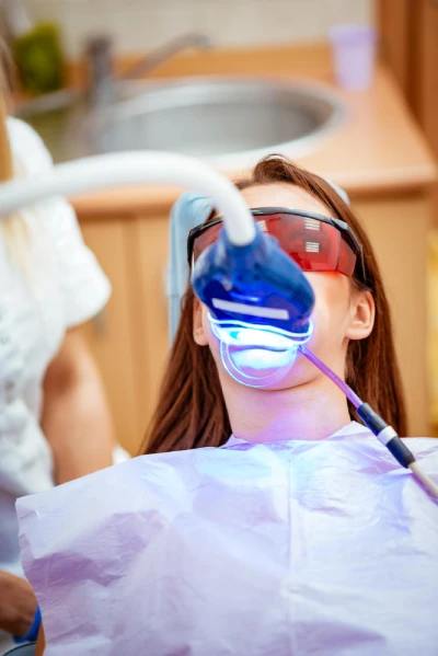 Custom trays used for professional teeth whitening treatment