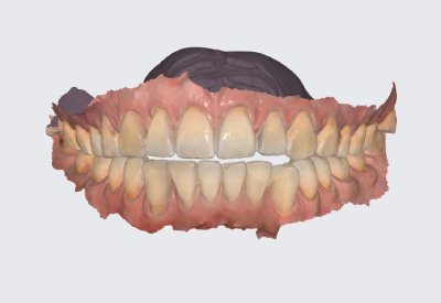 3D digital model of teeth