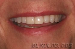 Adult orthodontics and composite bondings second case after