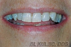 Adult orthodontics and composite bondings second case before