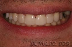 After adult orthodontics and composite bondings