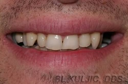 Before adult orthodontics and composite bondings