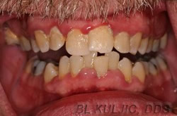 Before adult orthodontics and custom whitening