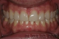 After dult orthodontics and porcelain veneers