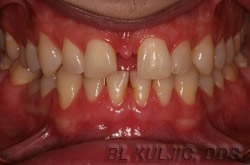 Before adult orthodontics and porcelain veneers