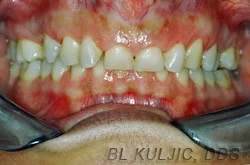 Before photo of adult orthodontics and porcelain veneers case showing bite and smile concerns