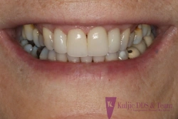 After aesthetic restorative dentistry with limited orthodontic tooth movement and porcelain veneers