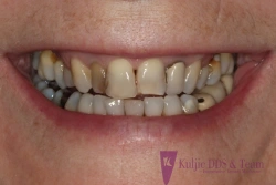 Before aesthetic restorative dentistry with limited orthodontic tooth movement and porcelain veneers