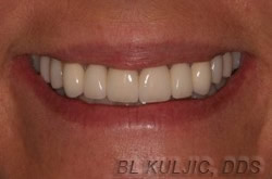 New bridges and composite bonding restoring an even smile