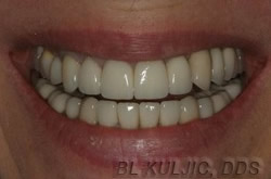 After photo of complex reconstructive and implant dentistry case by Dr. Kuljic