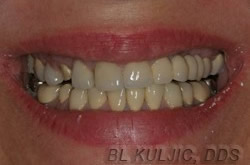 Before photo of complex reconstructive and implant dentistry case by Dr. Kuljic
