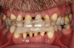 Before complex restorative and implant rehabilitation