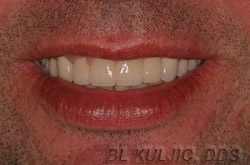 After photo of complex restorative and implant rehabilitation case by Dr. Kuljic