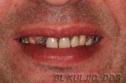 Before photo of complex restorative and implant rehabilitation case by Dr. Kuljic