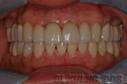 After photo of complex restorative rehabilitation case by Dr. Kuljic