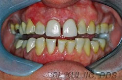 Before photo of complex restorative rehabilitation case by Dr. Kuljic