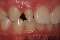 Irregular tooth before single-tooth composite bonding