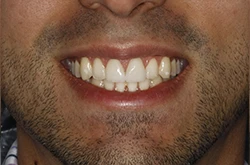 Composite veneers case after