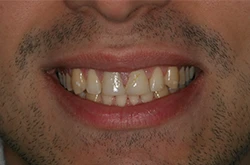 composite-veneers-case-before