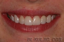 After composite veneers treatment