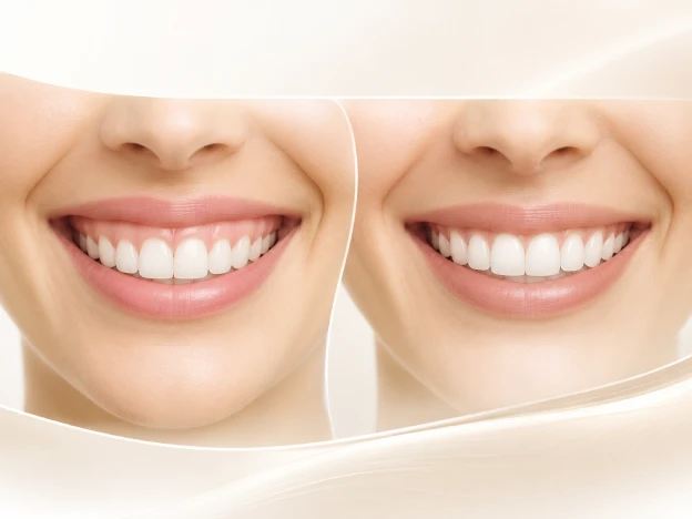 Cosmetic Crown Lengthening illustration