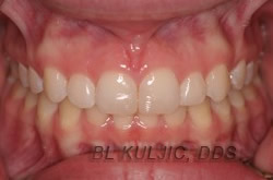 Close-up of gum line before crown lengthening