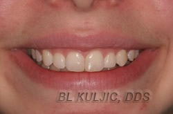 Gummy smile before cosmetic crown lengthening