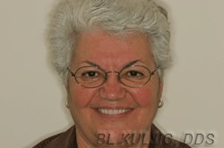A complete denture restoring a natural-looking smile
