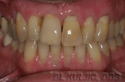 Front tooth replaced with an implant, with whitening and bonding