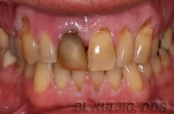 Failing front tooth before treatment