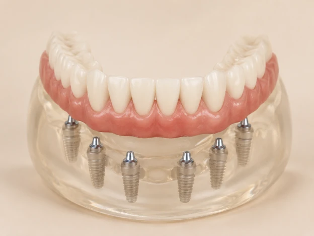 A fixed denture positioned above six dental implants in the lower jaw
