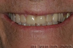 Smile restored with a bridge and composite bonding across the teeth