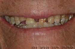 Worn and uneven teeth before full-mouth restoration