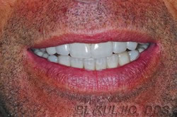 After photo of full mouth oral rehabilitation case by Dr. Kuljic
