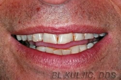 Before photo of full mouth oral rehabilitation case by Dr. Kuljic