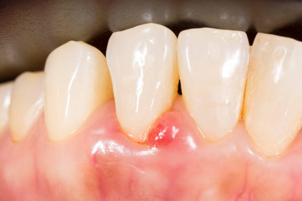 gum-disease-gingivitis