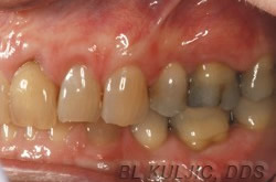 After gum grafting