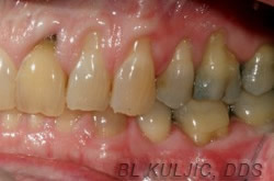 Before gum grafting