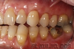 Gum grafting second case after