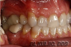 Gum recession after