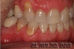 Gum recession before